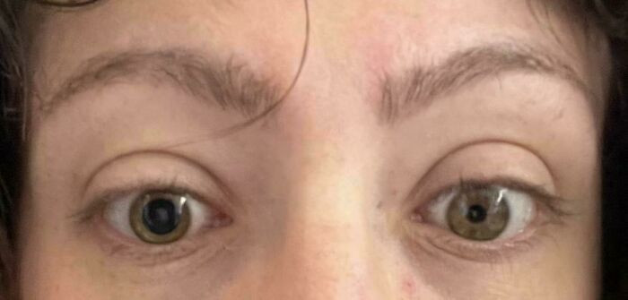"My Pupils Became Asymmetrical During A Cluster Headache"