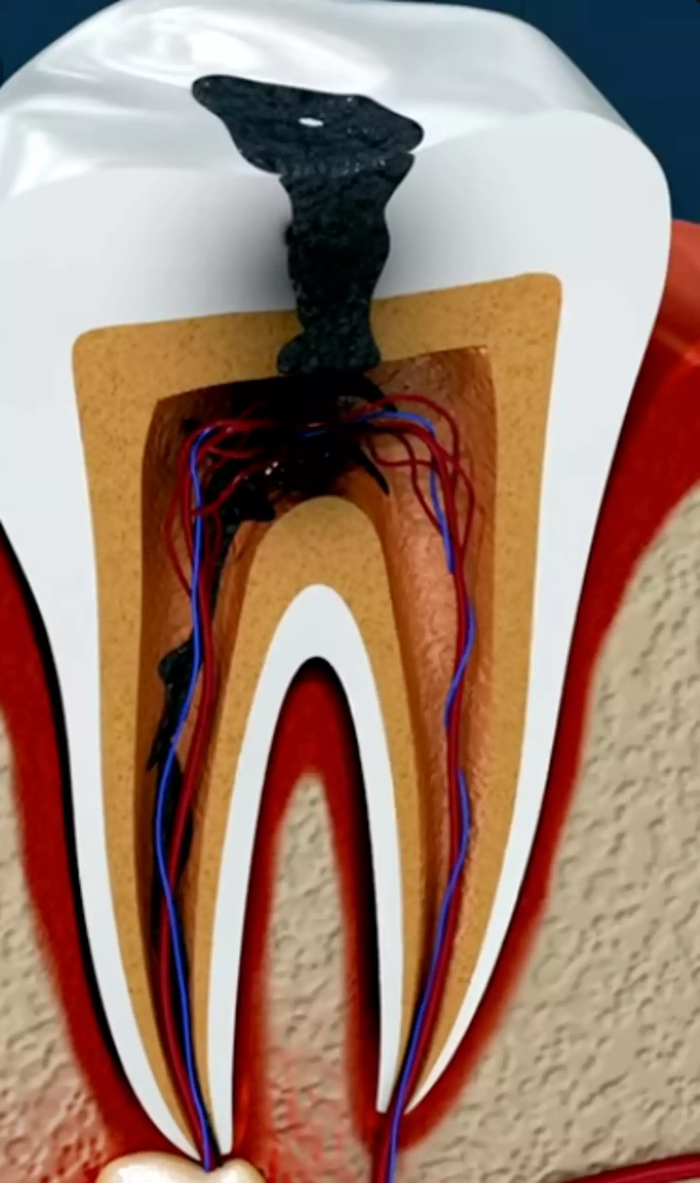 Once the infected material is removed, the empty canals are cleaned and shaped to prevent further infection.