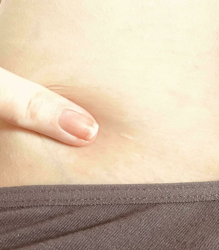 "My Friend Has Had Three Life-Saving Heart Surgeries. These Are Her Scars"