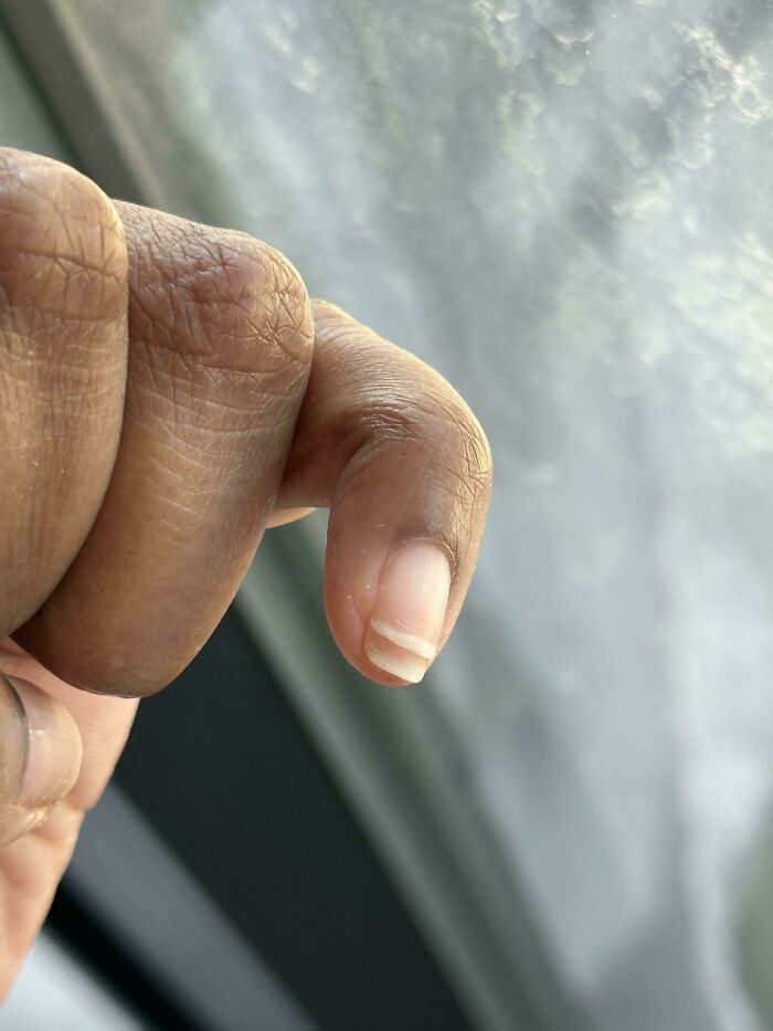 "My Nail Split, Now I Have Two Little Nail Tips"