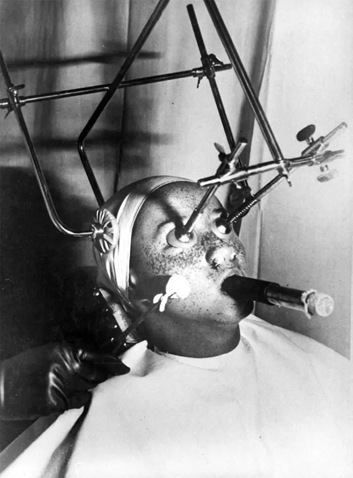 Freckle Removal Device, 1930