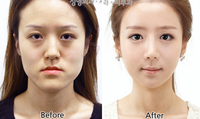 "Korean Plastic Surgeons Are Amazing"