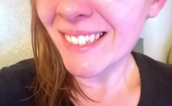 "One Of My Adult Teeth Never Came In... So I'm Stuck With A Forever-Baby Tooth"