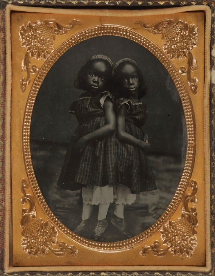 "Conjoined Twins Millie And Christine, Known As 'The Two Headed Nightingale'"