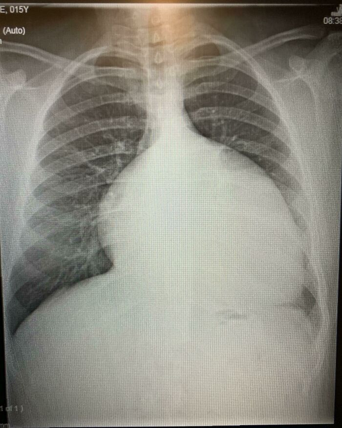 "My Enlarged Heart At Age 15 (2012) Before I Had Surgeries"