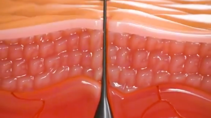 Simulation showing skin response to pulling out a hair follicle, revealing damage