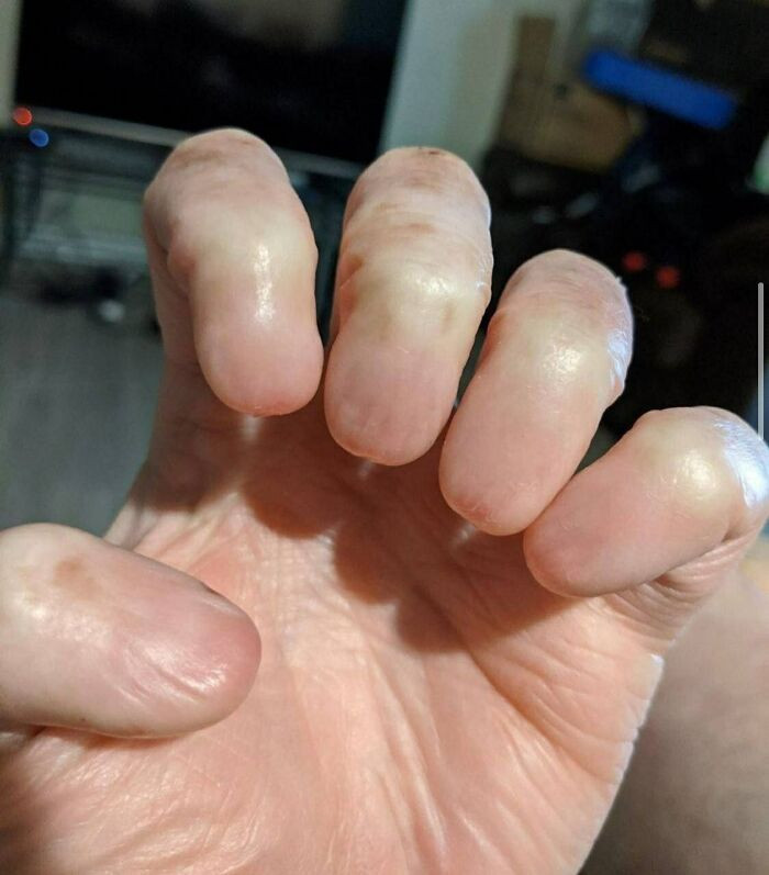 "Anonychia Is The Partial Or Total Absence Of One Or More Nails On The Fingers Or Toes"