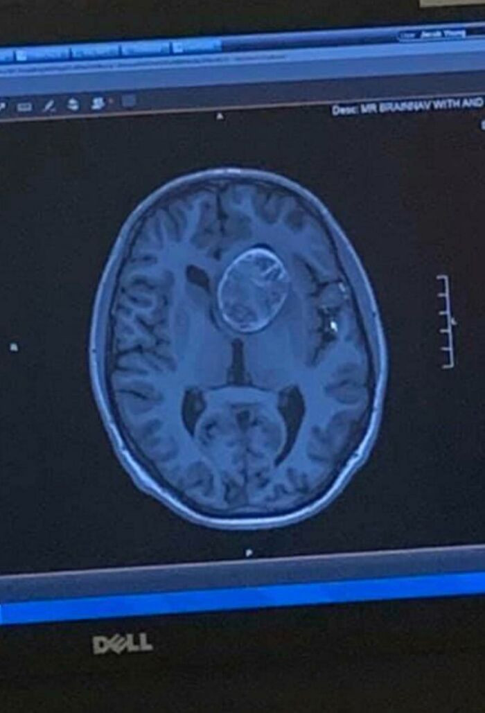 "A CT Scan Of My Brain And The 6.2 Cm Dermoid Cyst I Had Surgically Removed In January Of 2019. My Brain Somehow Managed To Grow Around It Without Causing Me To Become Mentally Or Physically Disabled For 22 Years"
