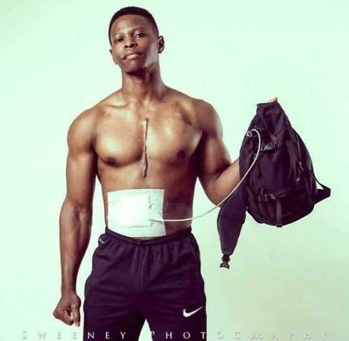"After a virus destroyed his heart in 2012, Andrew Jones, a fitness model, was fitted with an artificial heart pump he carries in a backpack 24/7."