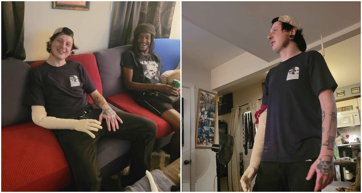 Man Lost His Arm, Then His Cousin Turned Up With a Crocheted Replacement, Complete With a Bone