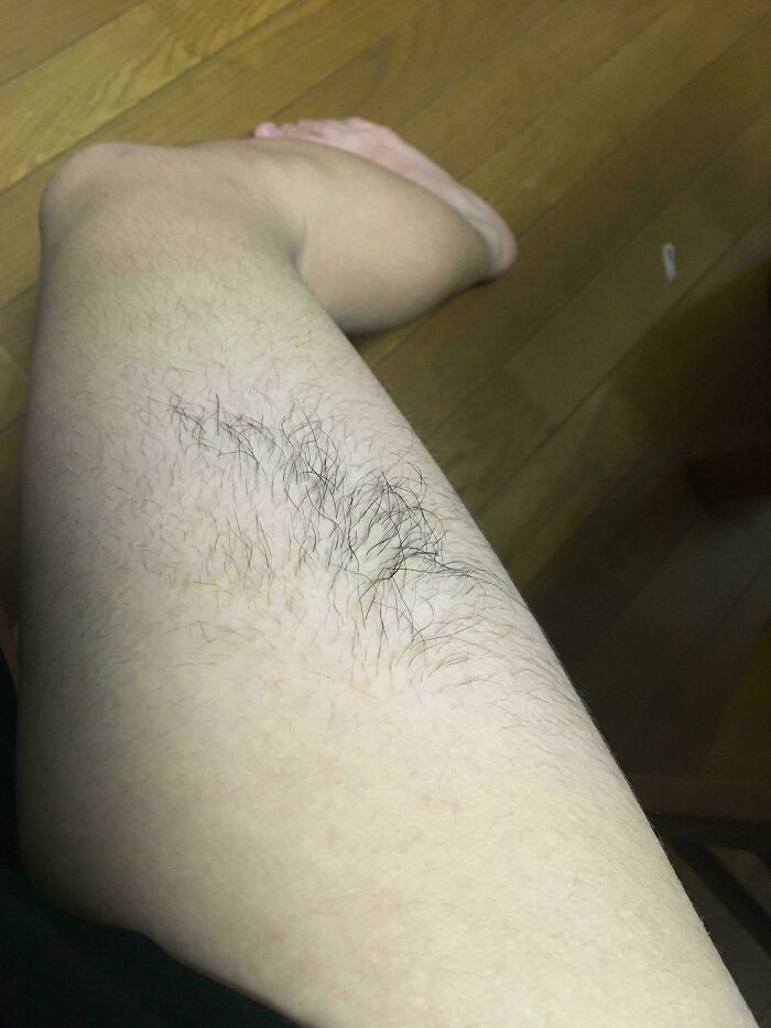 "I Have A Patch On My Leg With An Abnormal Amount Of Hair"