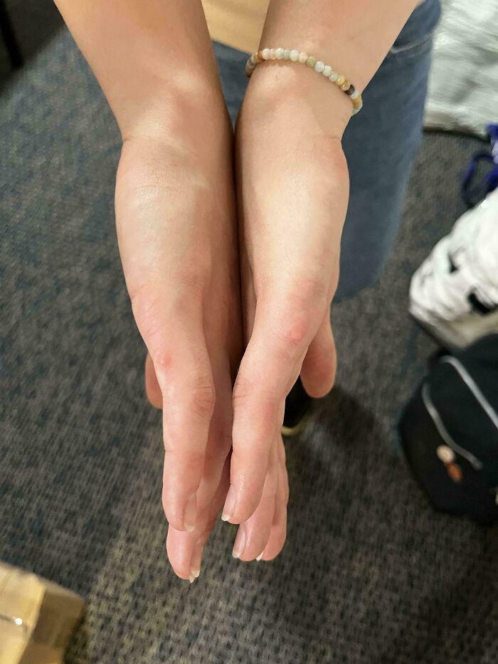 "My Roommate Was Born With 12 Fingers And Had Them Amputated As An Infant"
