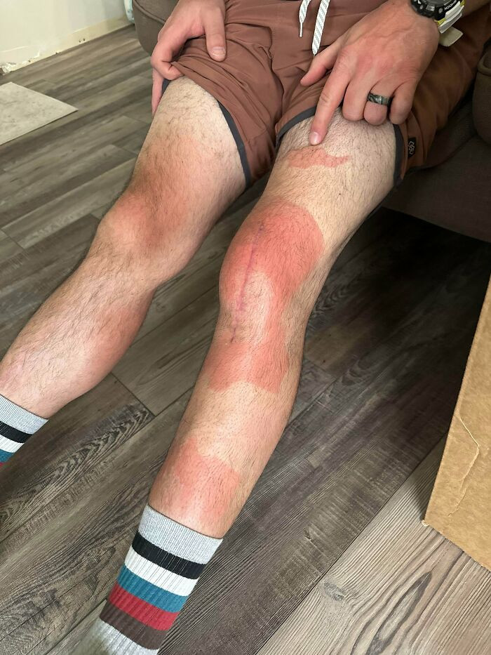 "Went To My Son's Soccer Game With My Knee Brace On… Forgot The Sunscreen"