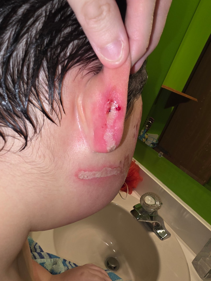 Boy with severe facial burns after a kitchen explosion, receiving care