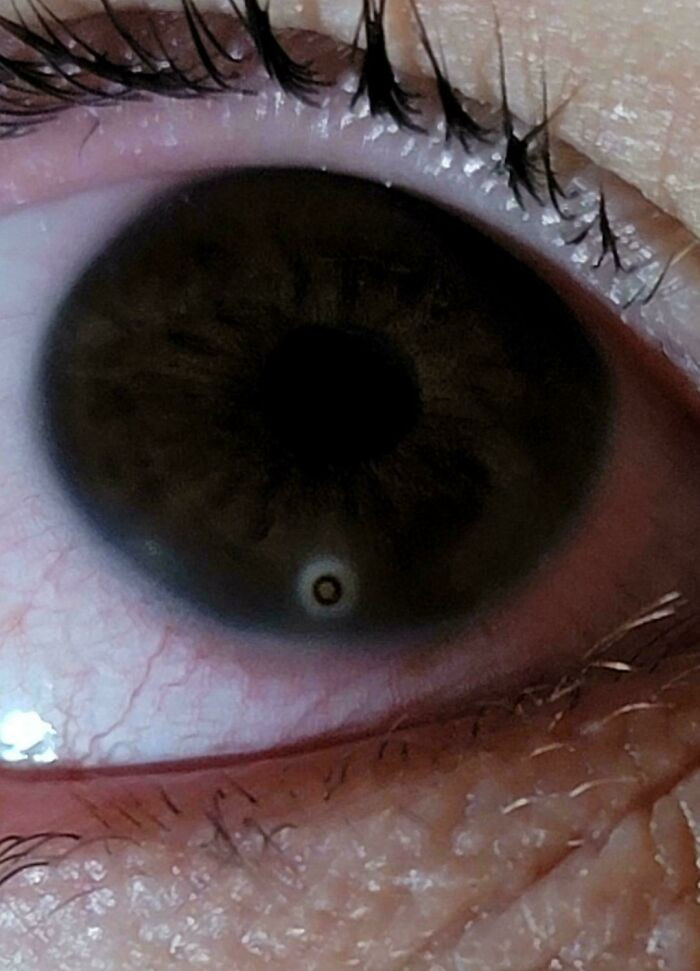 "I Got A Piece Of Metal Stuck In My Eye And It Left A Rust Ring After It Fell Out"