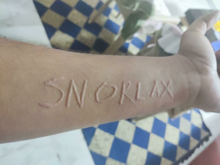 "I Have A Skin Condition Called Dermatographia, Due To Which Lightly Scratching My Skin Causes Raised, Red Lines Where I've Scratched"