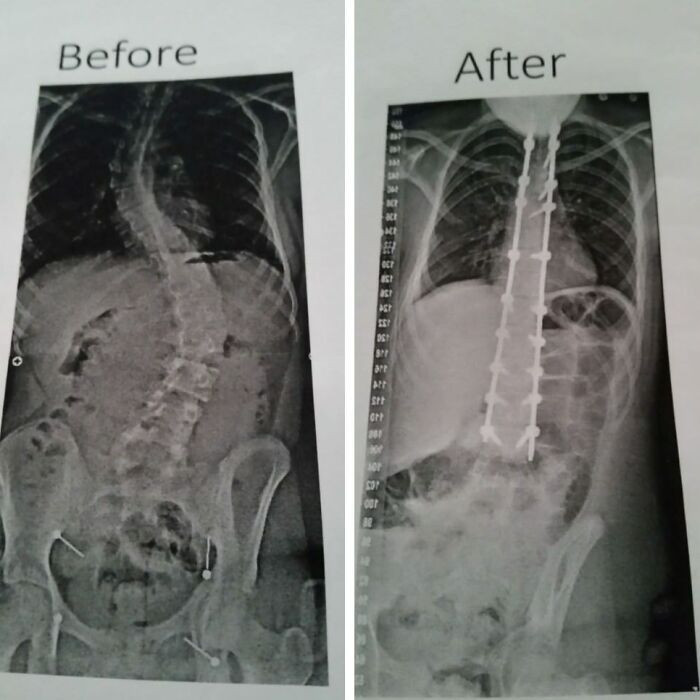 "Before & After A Total Spinal Fusion"