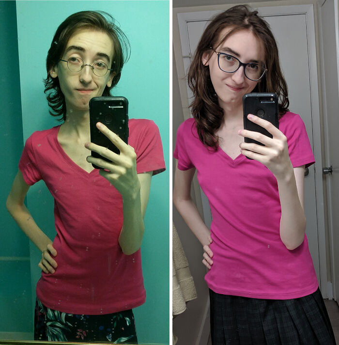 "[98 Lbs > 114 Lbs = 16 Lbs Gained] (12 Months) My Marfan Syndrome Keeps Me On The Thin Side, But I Think I Look A Lot Less Sickly Now!"