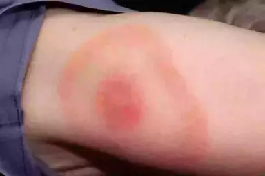 Here is what the rash should look like