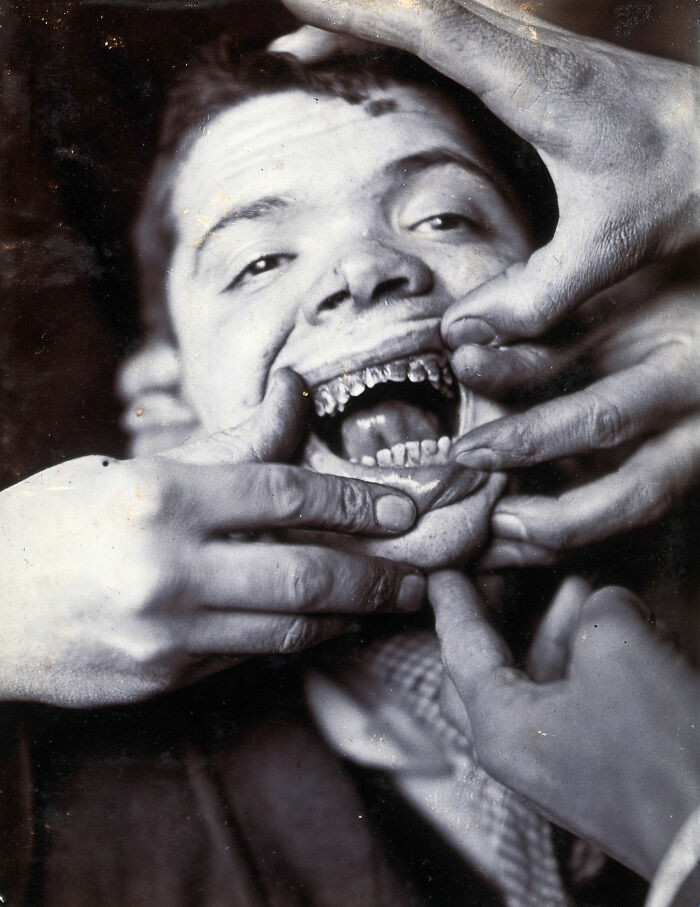 "Friern Hospital, London: A Boy With Rotten Teeth. Photograph, 1890/1910"