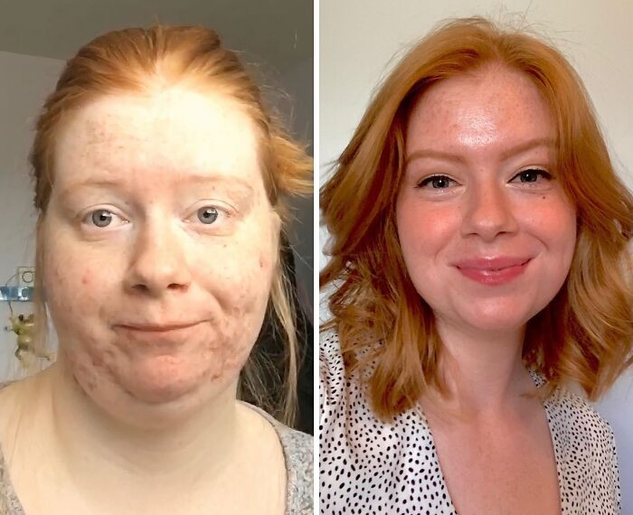 "I Used To Be Afraid Of Having Short Hair Because Of The Weight In My Face. Today, I Said Goodbye To The Old Me And Embraced My New Life."