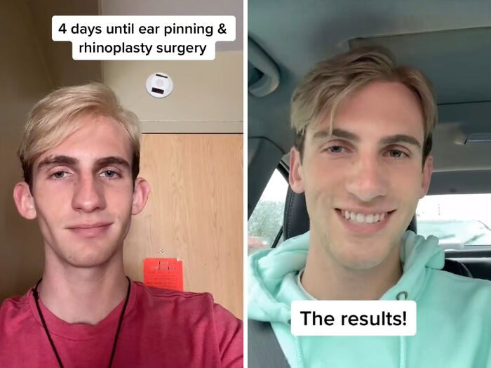 26. Ear pinning & rhinoplasty.