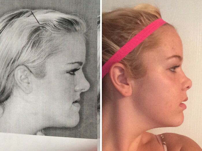 "The Before And After Of My Jaw Surgery"