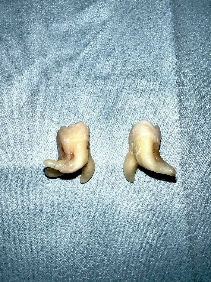 "My Wisdom Teeth Were Taken Out Today"
