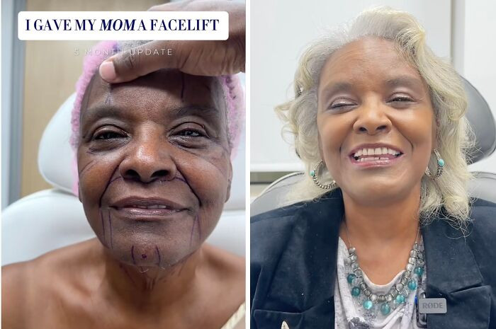 20. Mom's facelift.