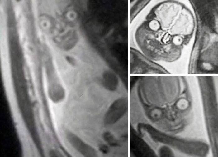 "Pregnant Woman MRI Scan Of The Fetus"