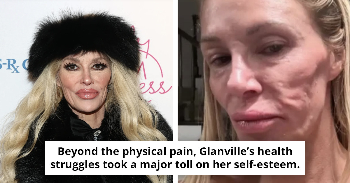 Brandi Glanville reveals startling details about the source of her facial 'parasite,' stating it led her to 'lose everything.'