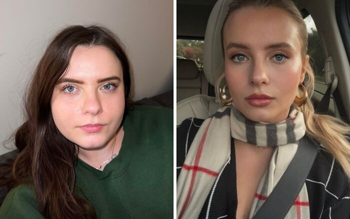 "Crazy How Lip Filler, Botox, Weight Loss, And A Hair Color Change Can Transform A Person"