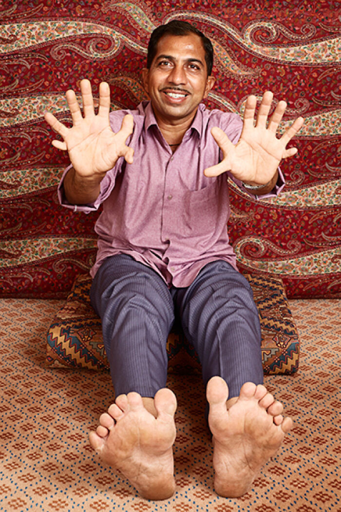 "This Guy With 14 Fingers And 14 Toes!"
