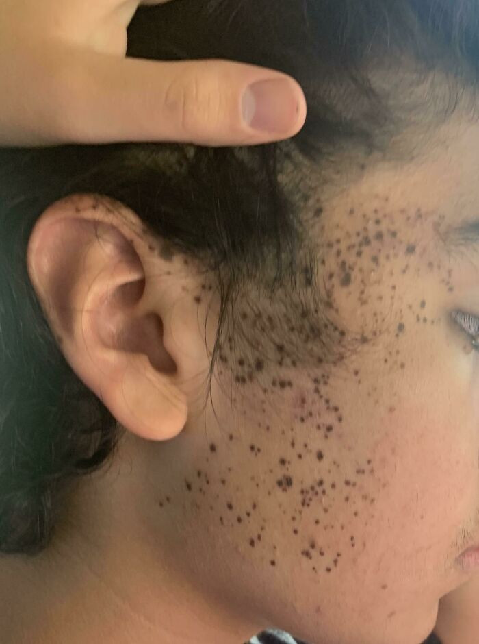 "I Have A Lot Of Freckles Bunched Up On Just One Side Of My Face"