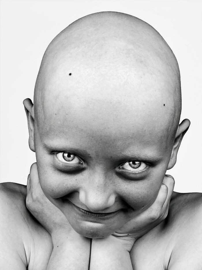 “Teresa” - Alopecia