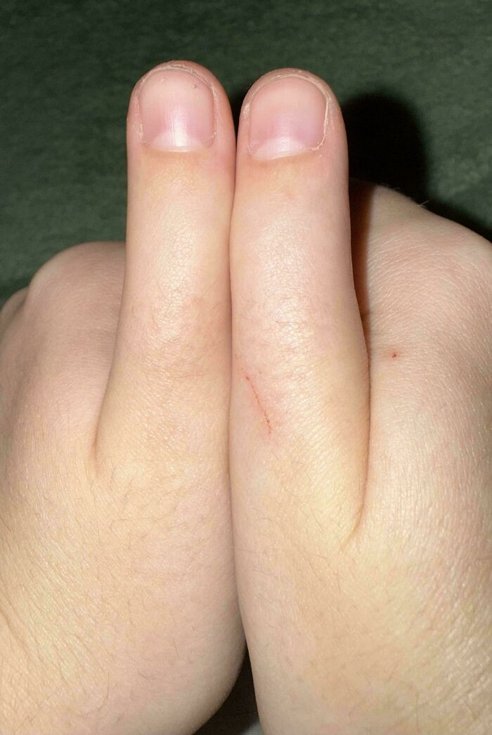 "I Have A Birth Defect That Makes Me Unable To Bend My Thumbs"