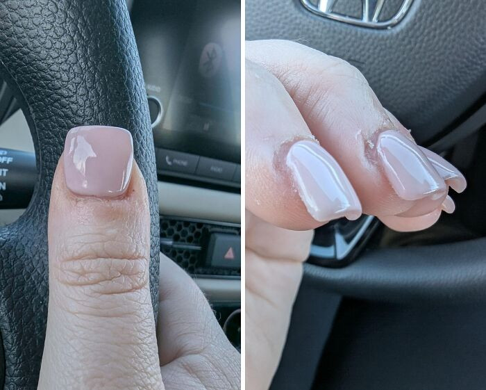 "It Only Cost Me $80 To Turn My Thumbs Into Toes!"