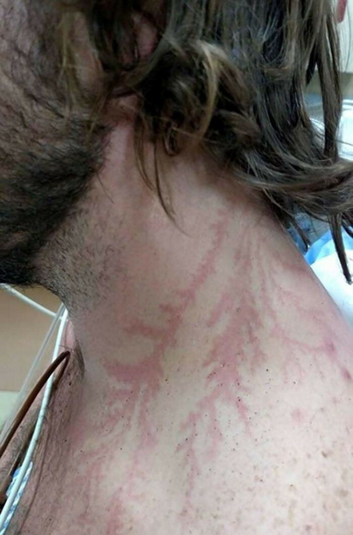 "Being Struck By Lightning Can Leave A Tattoo-Like Marking Or Scar Known As A Lichtenberg Figure"