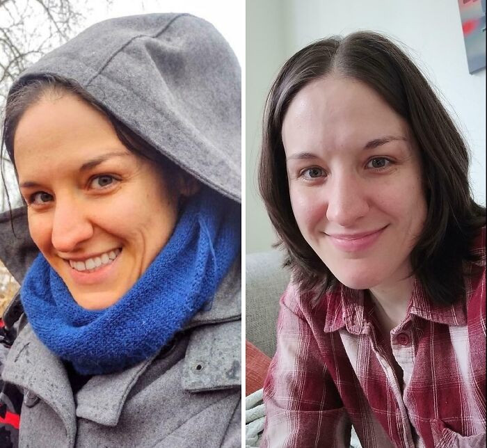 "Carotenosis Before And After. Left Was Me In December, Right Is Me Now After I Stopped Eating Carrots Every Day"
