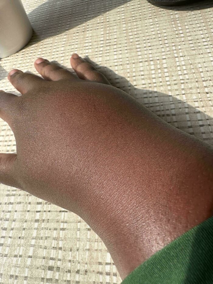 "When I Was Stung By A Wasp On A Walk, I Swelled Up In Minutes"