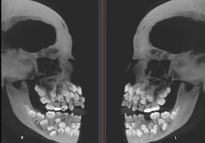 An X-ray of a patient with hyperdontia, a condition where a person has more teeth than normal. Most adults have 32 teeth, but this individual had 81.