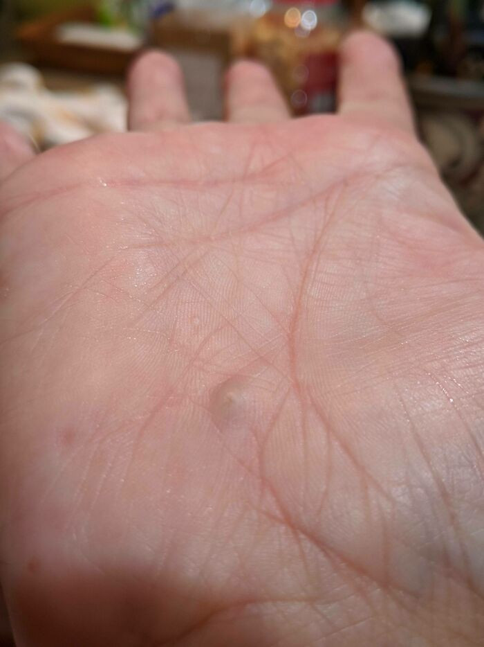"A Rock Working Its Way Out Of My Hand After A Bicycle Accident Over 25 Years Ago"