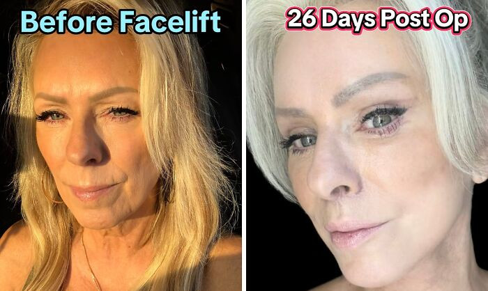 6. Facelift.