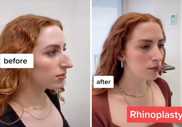 5. Rhinoplasty.