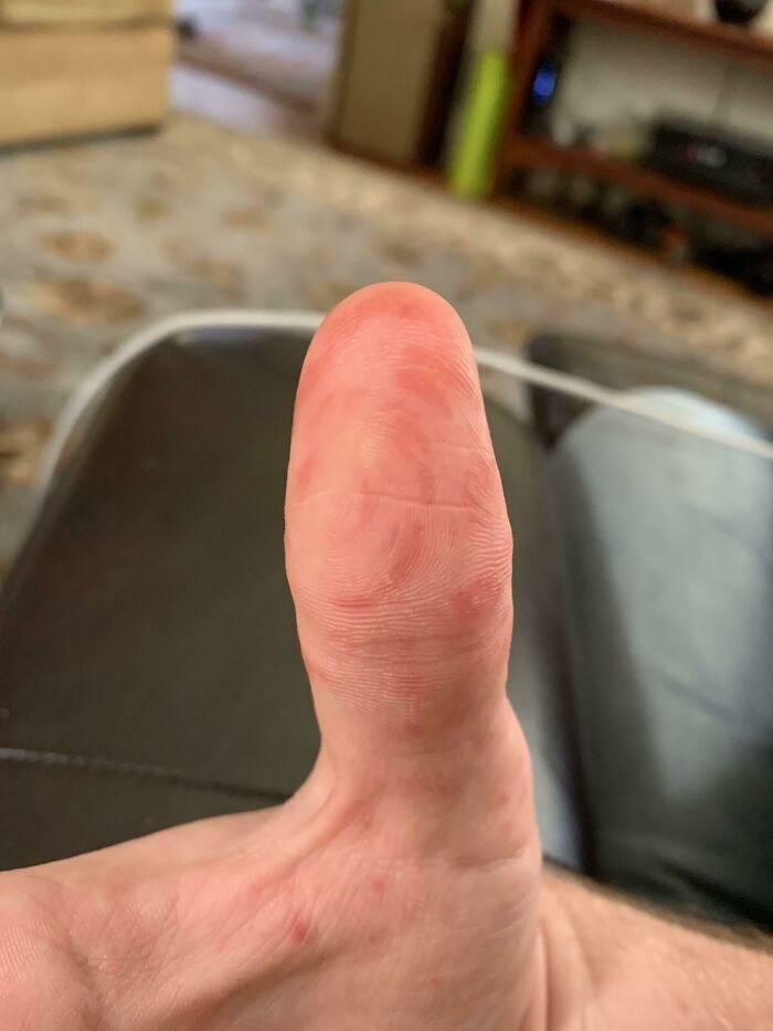 "Came Down With Hand, Foot, And Mouth Disease. The Rashes On My Fingers Follow My Fingerprints"
