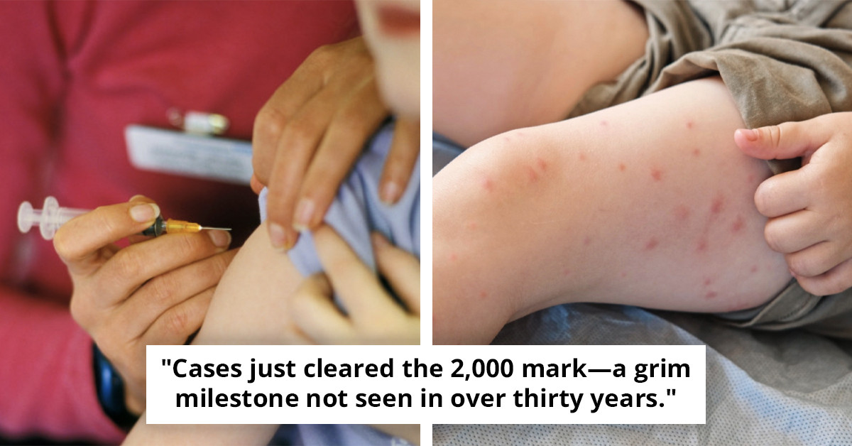 Critical Alert: Unprecedented Surge in US Disease Cases Exceeds 2,000 for the First Time in 3 Decades #PublicHealth #Alert