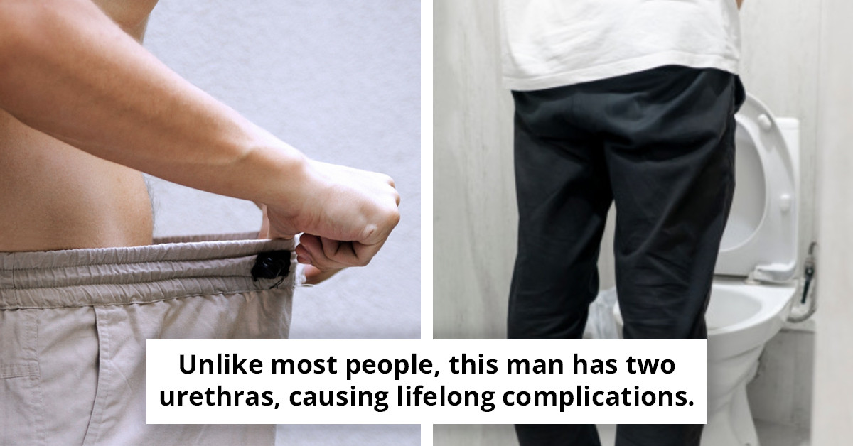 Man 'with a rare dual urethra' addresses the burning question on everyone's mind