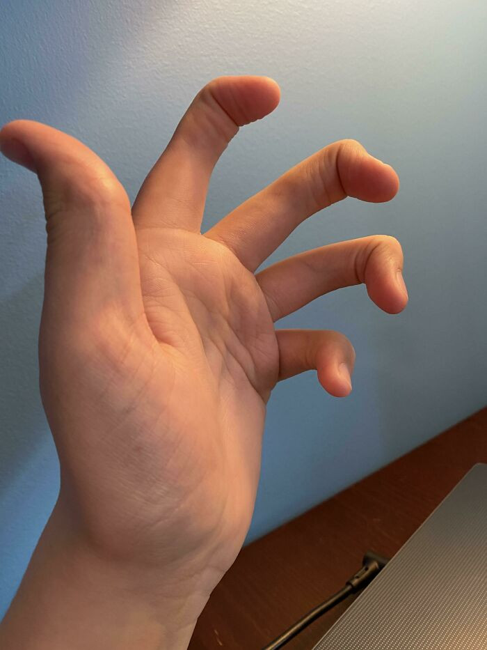 "None Of My Fingers Have A Middle Joint"