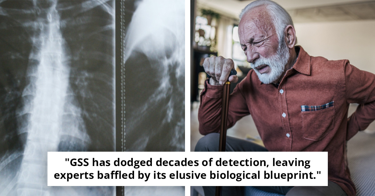 Puzzling 'disappearance bone condition' stumps medical experts with unknown origins