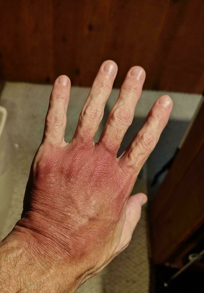 "The IV Bruise On My Hand 4 Days After Surgery"